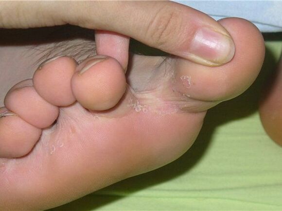 objawy grzybicy paznokci