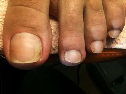 infekcja grzybicza płytki paznokcia