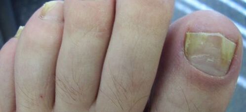 objawy grzybicy paznokci i jej leczenie octem