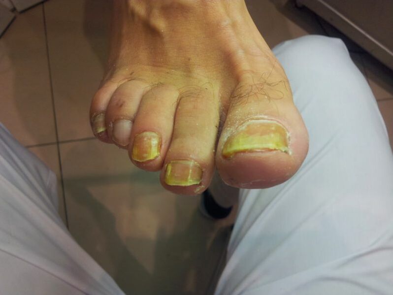 żółte paznokcie z grzybicą