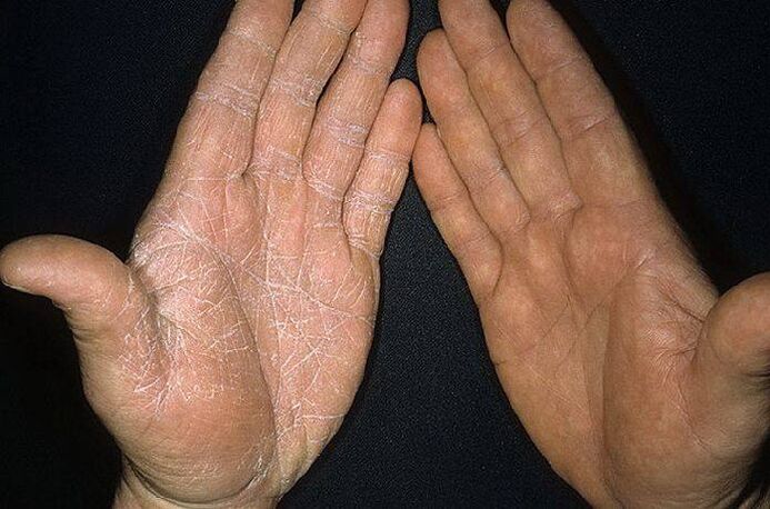 objawy grzybicy na skórze dłoni
