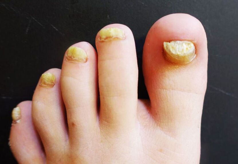 Nieestetyczny wygląd paznokci dotkniętych grzybicą