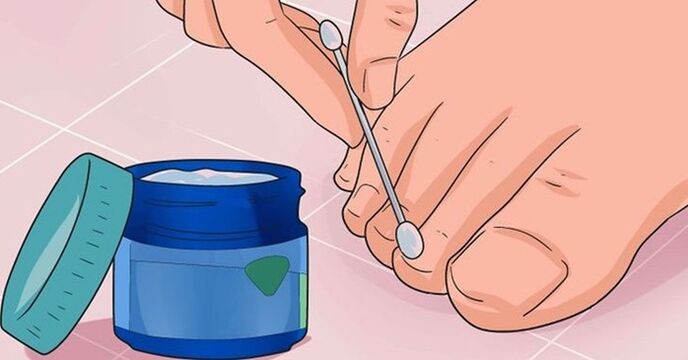 nakładanie kremu na paznokieć w celu leczenia grzyba