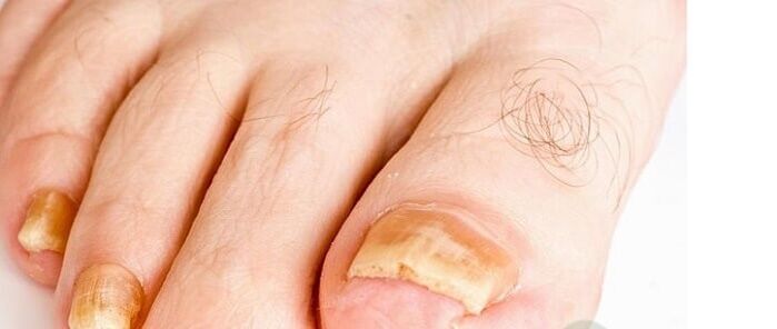odmiany grzyba paznokci