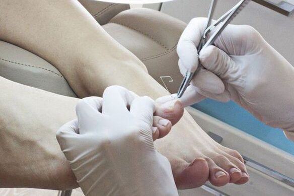 Mechaniczne usuwanie paznokci u stóp zaatakowanych przez grzyby