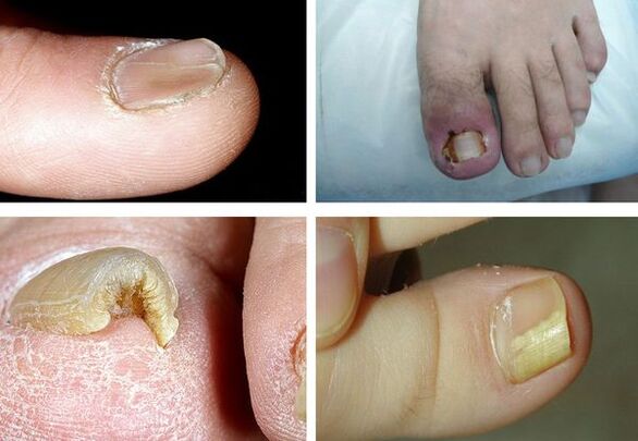 Objawy grzybicy paznokci na nogach