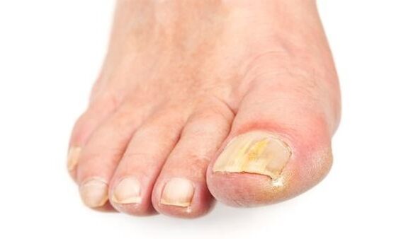 zażółcenie paznokcia z infekcją grzybiczą