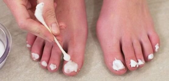 leczenie grzybicy paznokci u nóg za pomocą maści