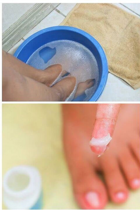 stosowanie naturalnych olejków w leczeniu grzybicy paznokci