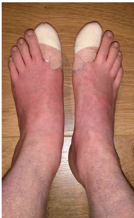 usuwanie paznokci u stóp zaatakowanych przez grzyby