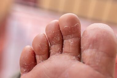 objawy infekcji grzybiczych palców stóp