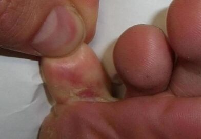 pęknięcie w palcu jest wynikiem infekcji grzybiczej